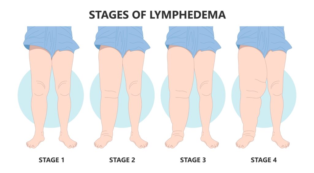 How Are Fat Legs and Lymphedema Linked Illustration