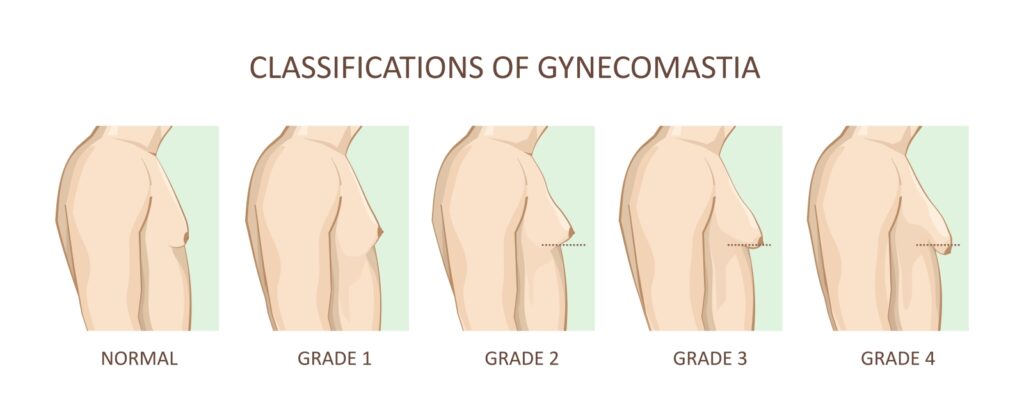 Detecting Gynecomastia: Symptoms, Causes, and Treatments