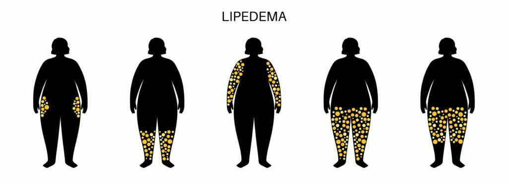 Lipedema types illustration.