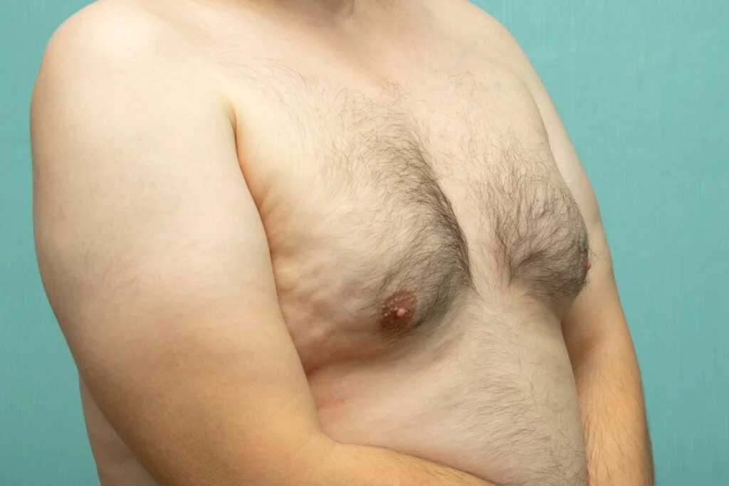 fat white middle-aged man with Gynecomastia, enlarged breast