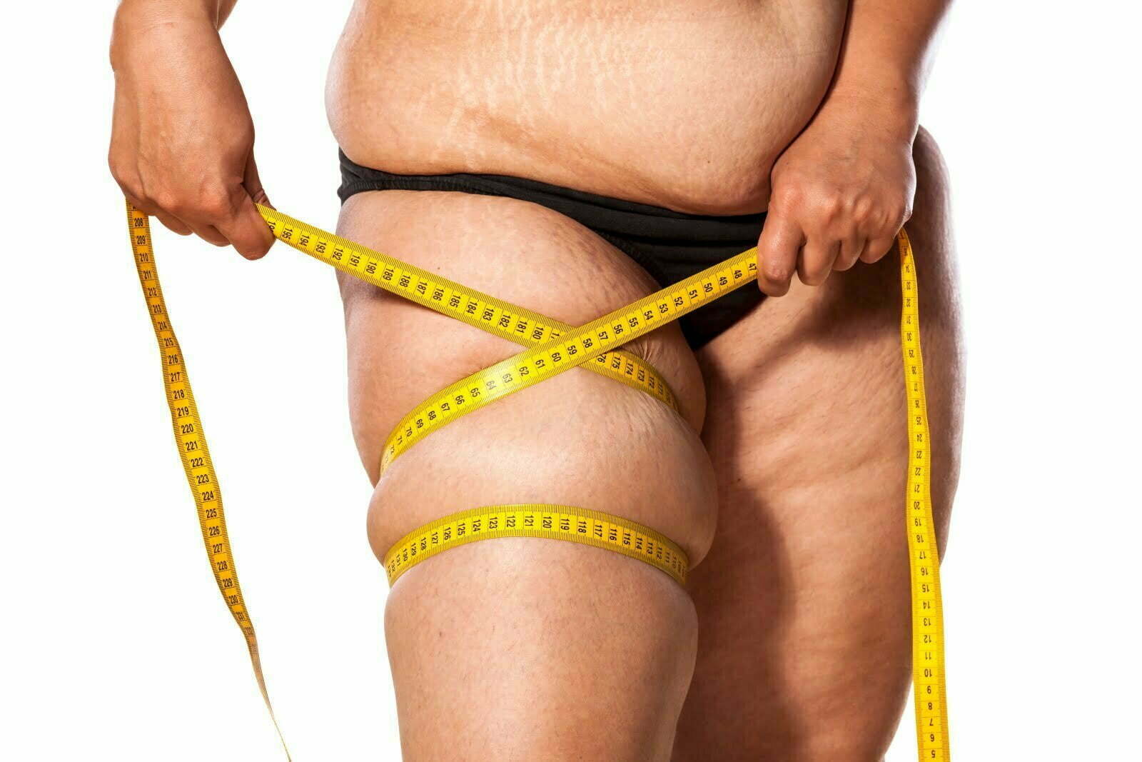 Lipoedema: The Condition You May Not Realise You Have and How to Treat it  “Liposuction
