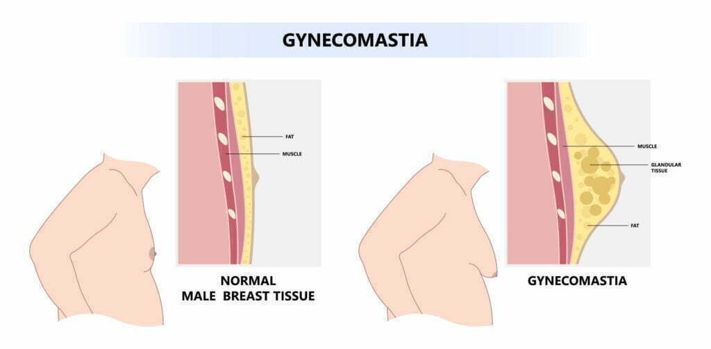 Gyno illustration. Normal male chest vs. male chest with gyno. 