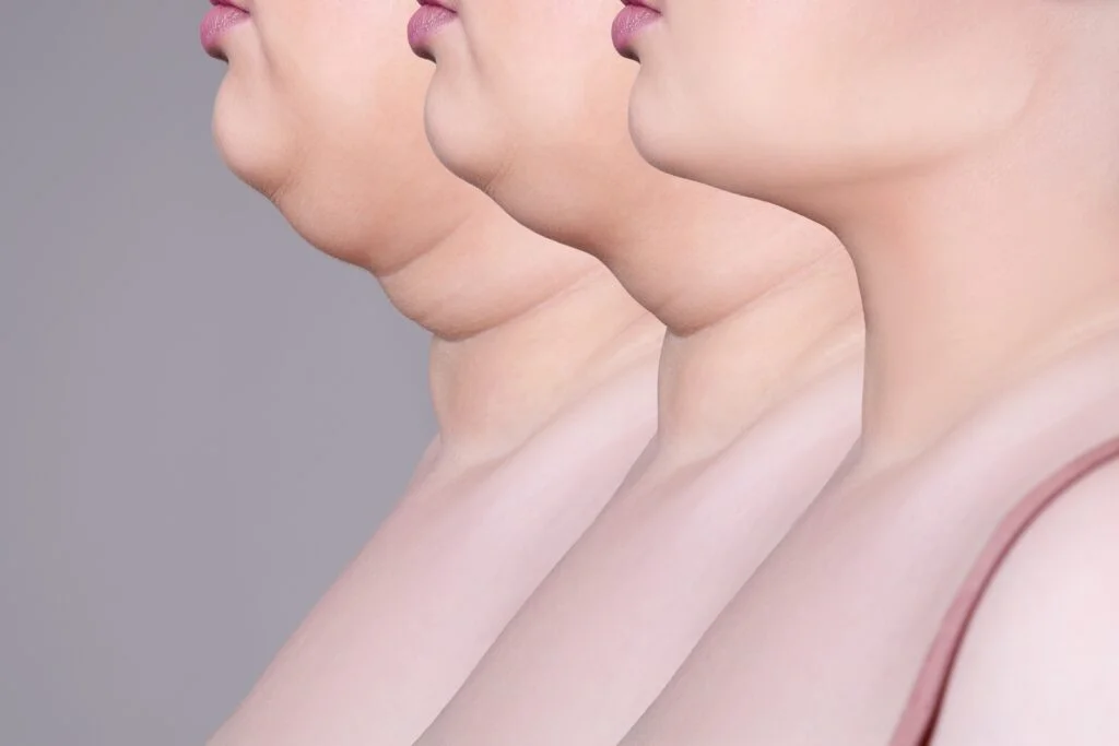 Double chin, skin rejuvenation and surgery on the neck, before after anti aging concept