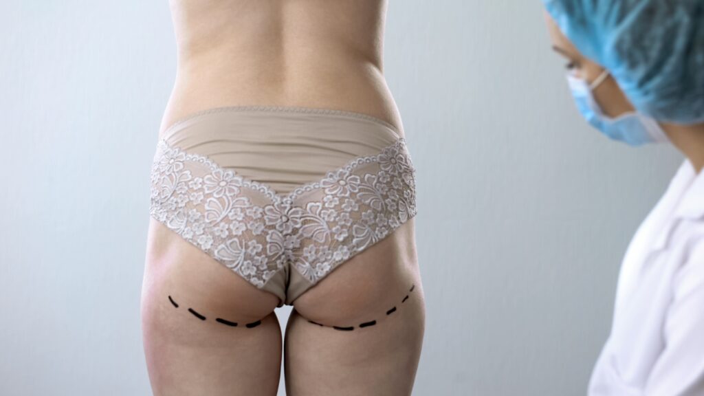 Sagging Buttocks Before And After - Salameh Plastic Surgery Center