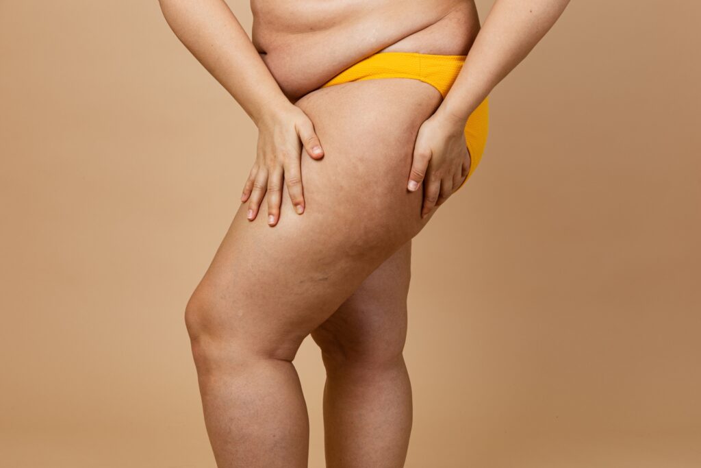 Overweight woman with fat thighs, obesity female legs
