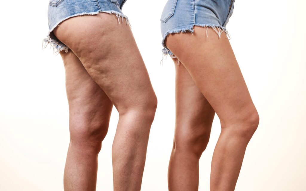 Scar-Like Marks On The Inner Thigh