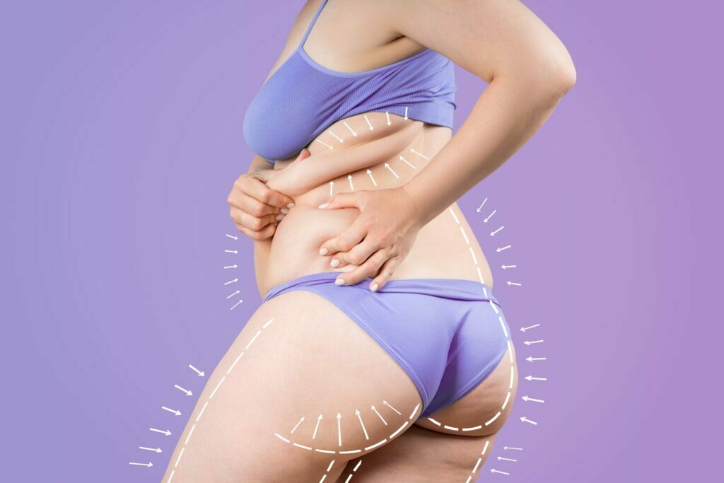 Buttocks, hip, back liposuction, fat and cellulite removal concept, overweight female body with painted surgical lines and arrows