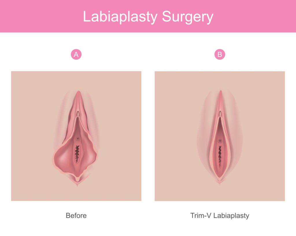 What do Normal Vaginas Look Like - Salameh Plastic Surgery Center