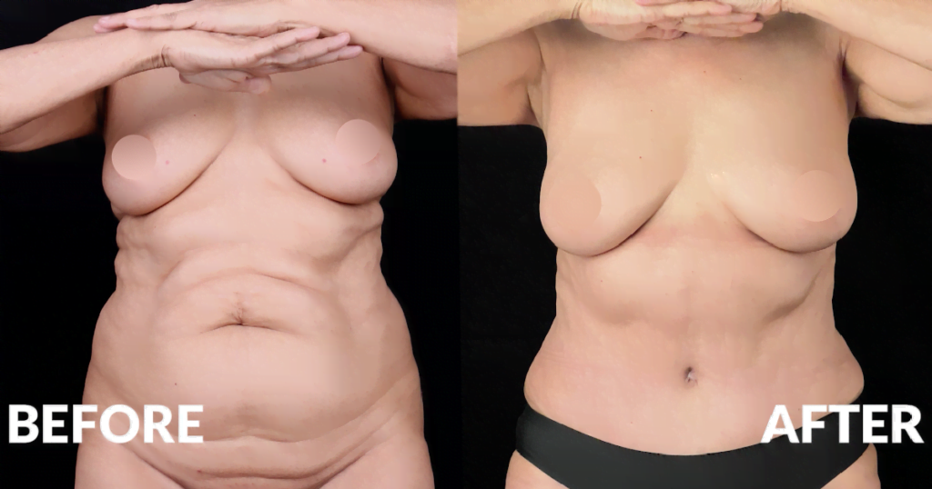 Overhang belly: Can I just get look to get rid of it or do I need a TT? :  r/PlasticSurgery