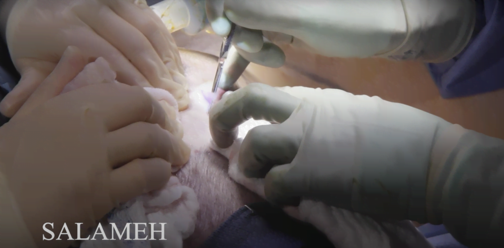 Patient's incision during a mini facelift surgery.