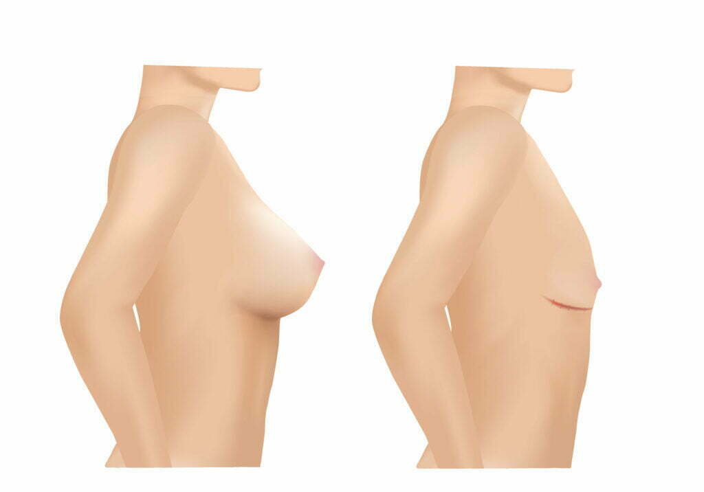 breast implant removal before and after illustration