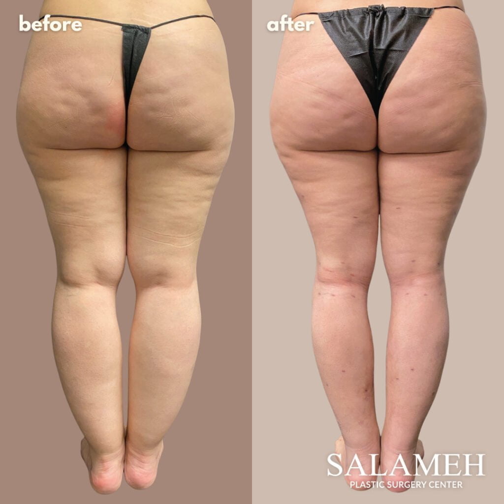 Awake Brazilian Butt Lift (BBL) - Salameh Plastic Surgery Center