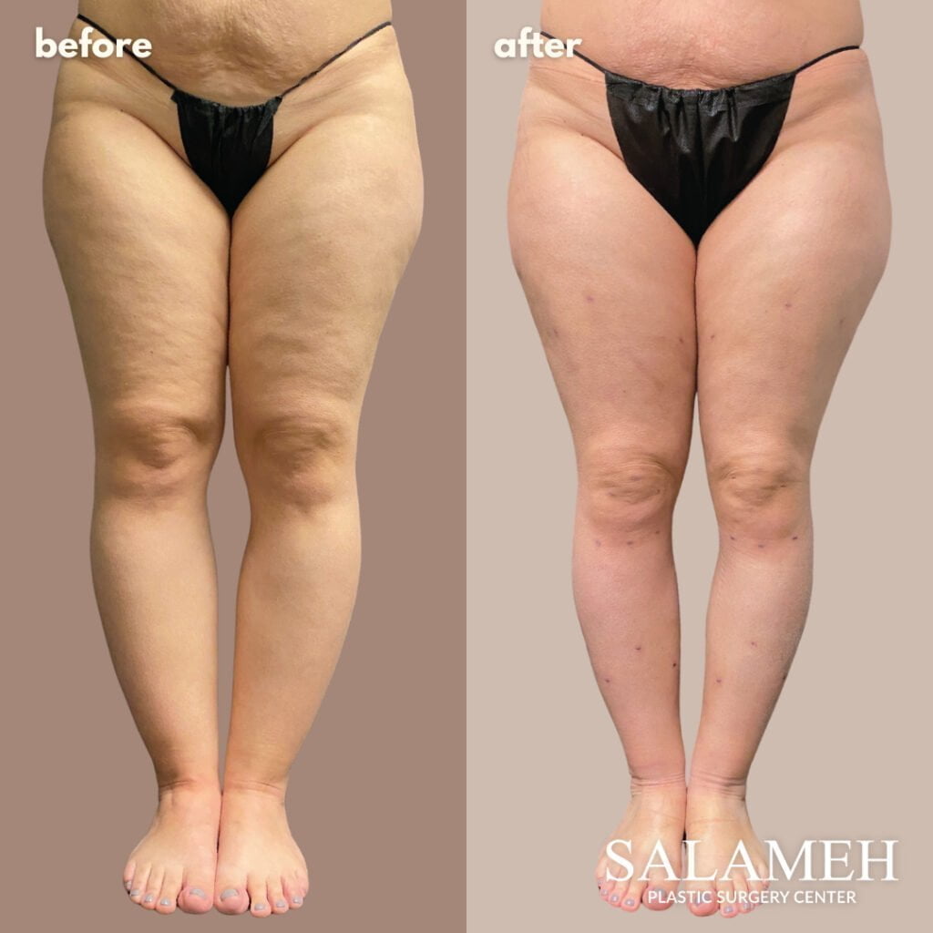 Lipedema Legs or Just Fat Legs? Crucial Things to Know - Salameh Plastic  Surgery Center