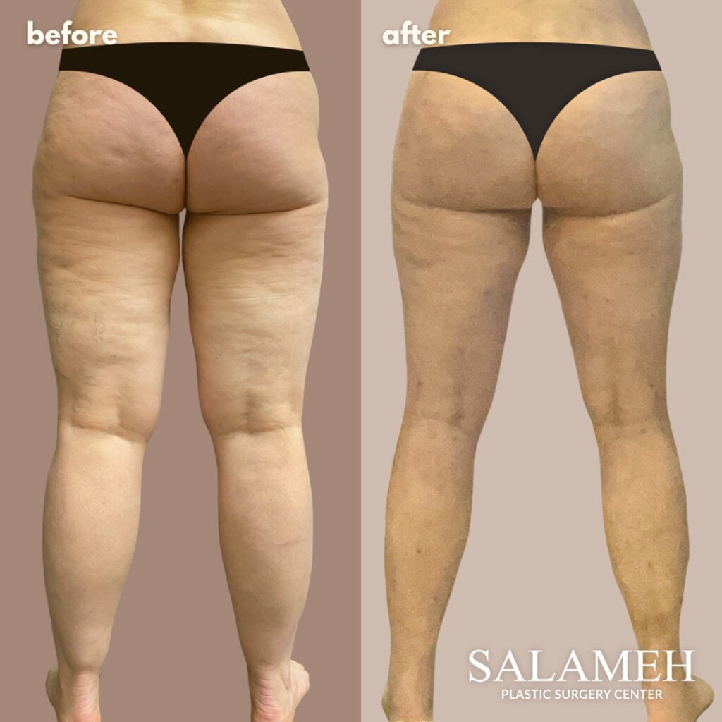 a before and after lipedema picture of a woman's butt.