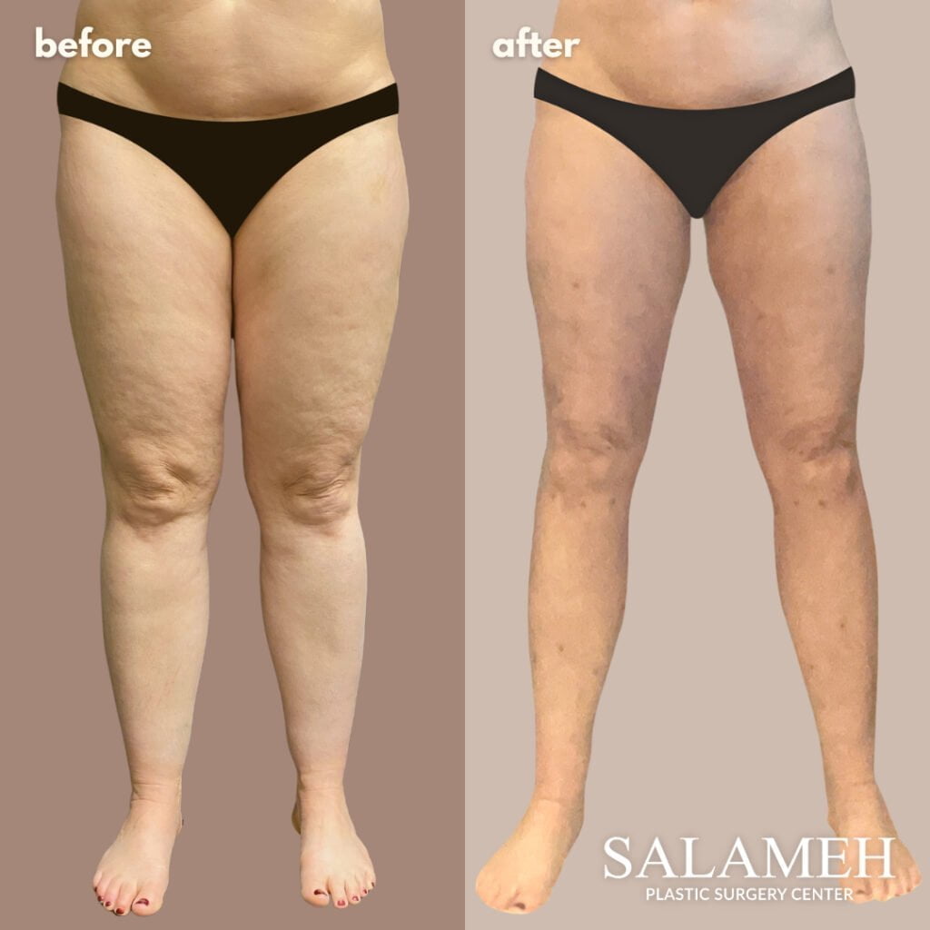 a before and after lipedema picture of a woman's legs.