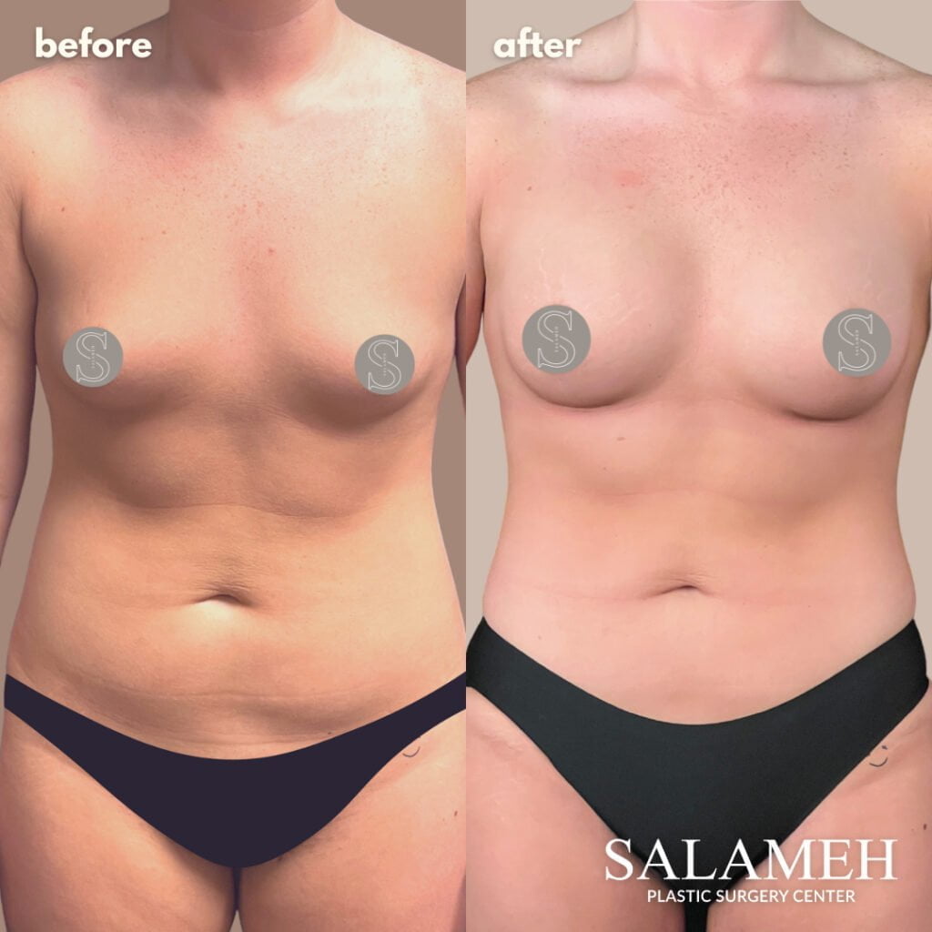 Awake Fat Removal (Liposuction) - Salameh Plastic Surgery Center