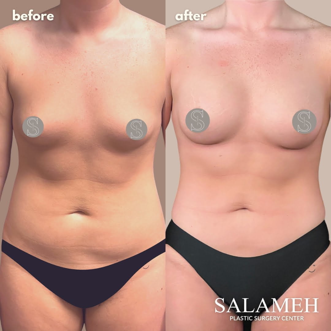 Body Sculpting Near Me - Salameh Plastic Surgery Center