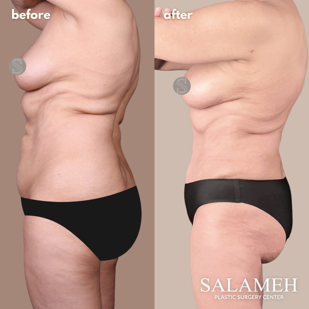 360 Lipo Without Tummy Tuck: Things You Need to Know - Salameh