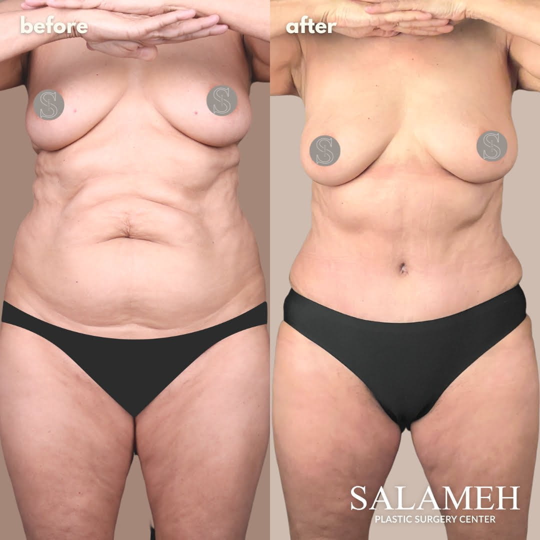 What Causes Belly Fat in Women & Proven Ways of Losing It - Salameh Plastic  Surgery Center