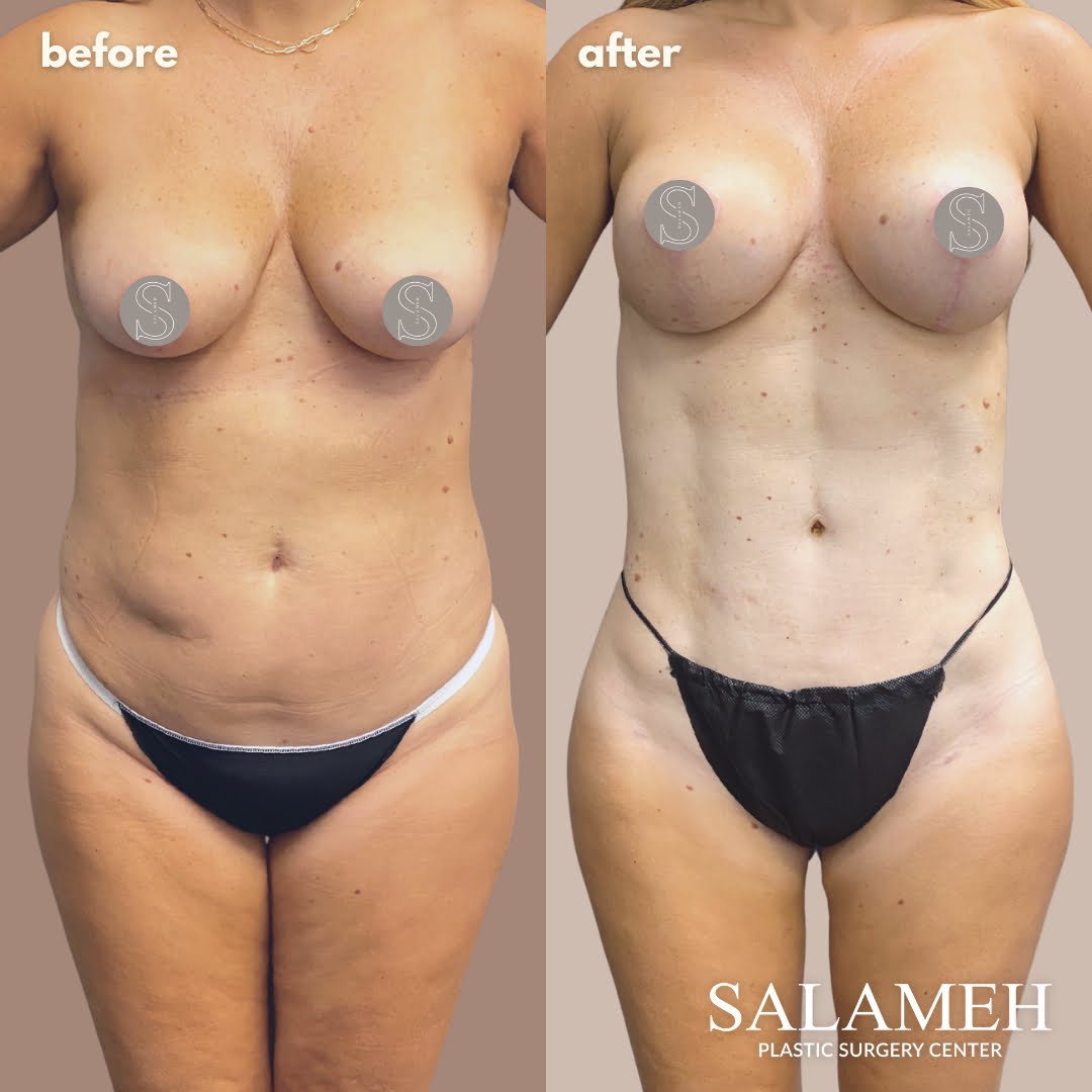 What Causes Inner Thigh Fat - Salameh Plastic Surgery Center