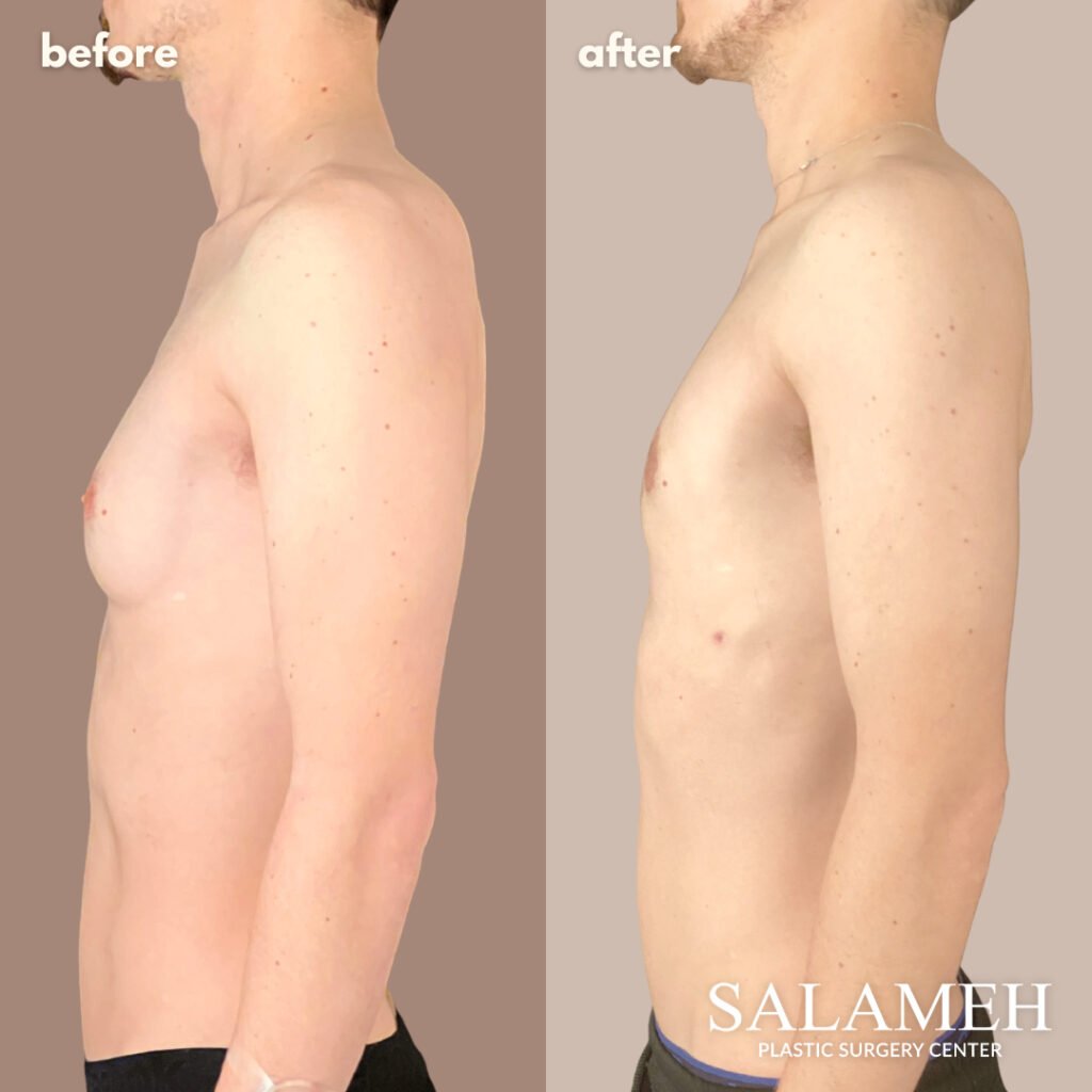 Male Chest Reduction (Gynecomastia) - Salameh Plastic Surgery Center