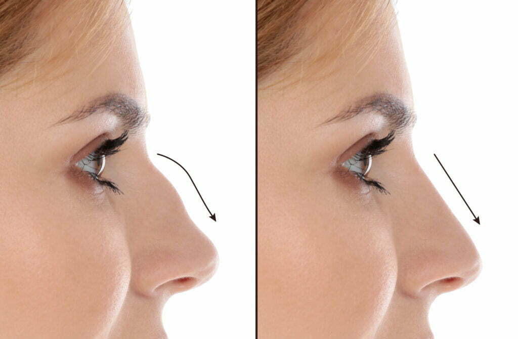 Perfect Nose Navigating The Rhinoplasty Healing Stages Salameh Plastic Surgery Center 1905