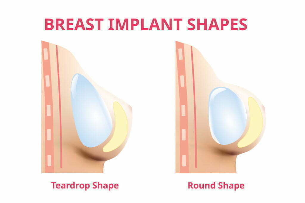 Tear Drop Breast - Round, but slightly less full at the top