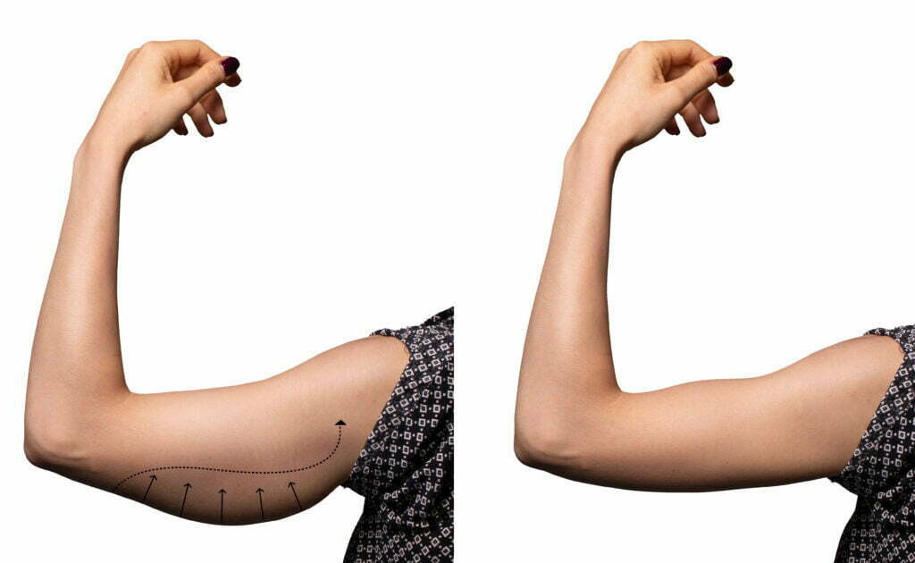 arm lift before and after photo of a woman who underwent invisible arm lift surgery.