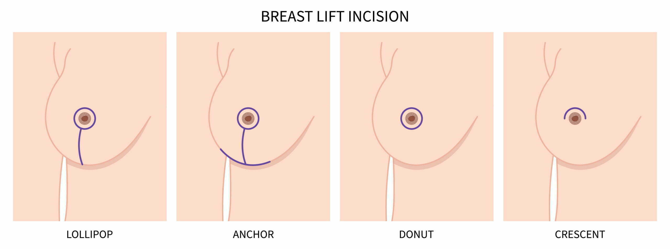 Understanding When You Will Need A Breast Lift & Not Just A Breast