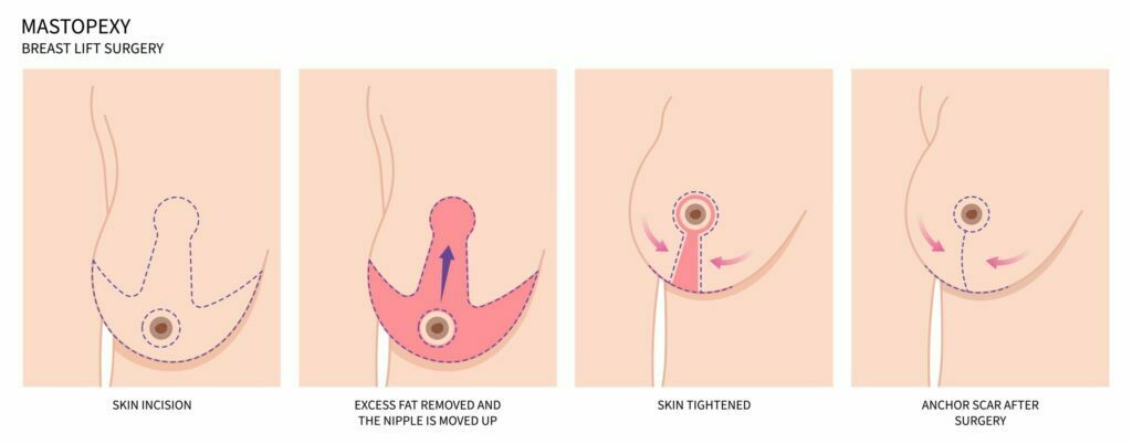 Mastopexy or breast lift surgery incission illustration.