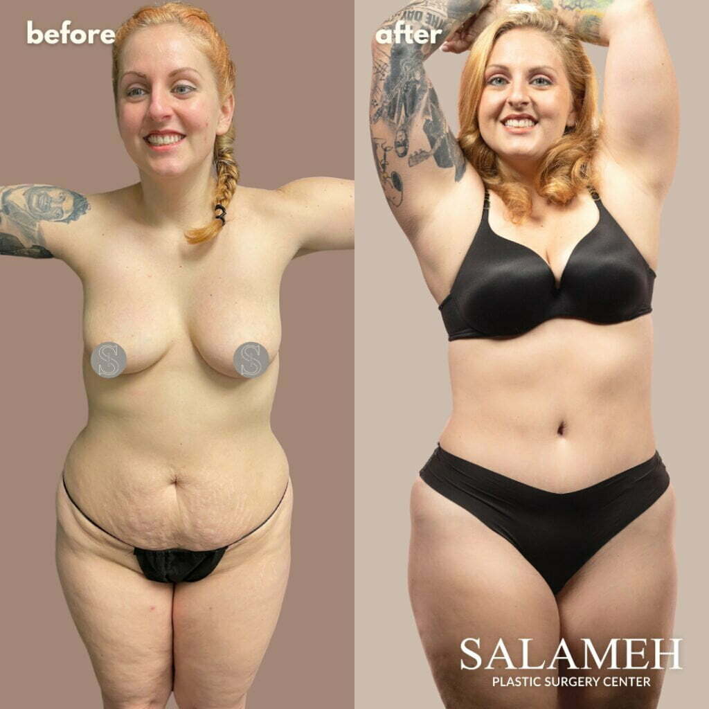 Mommy Makeover Before and After by Dr. Salameh photo number 2.