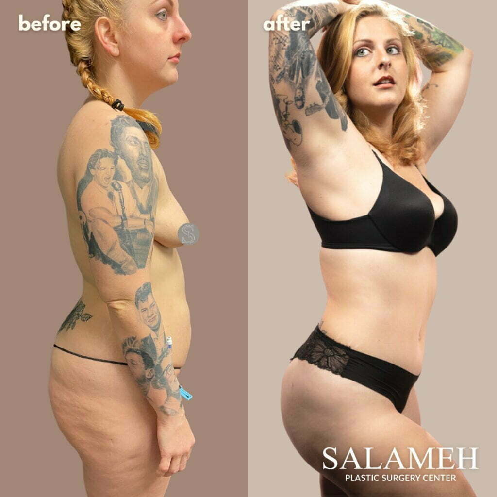 What Causes Belly Fat in Women & Proven Ways of Losing It - Salameh Plastic  Surgery Center