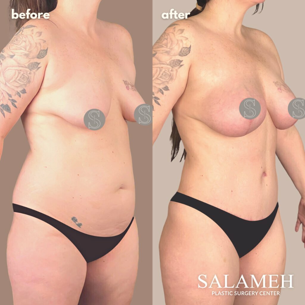 Mommy Makeover Before and After by Dr. Salameh photo number 1.