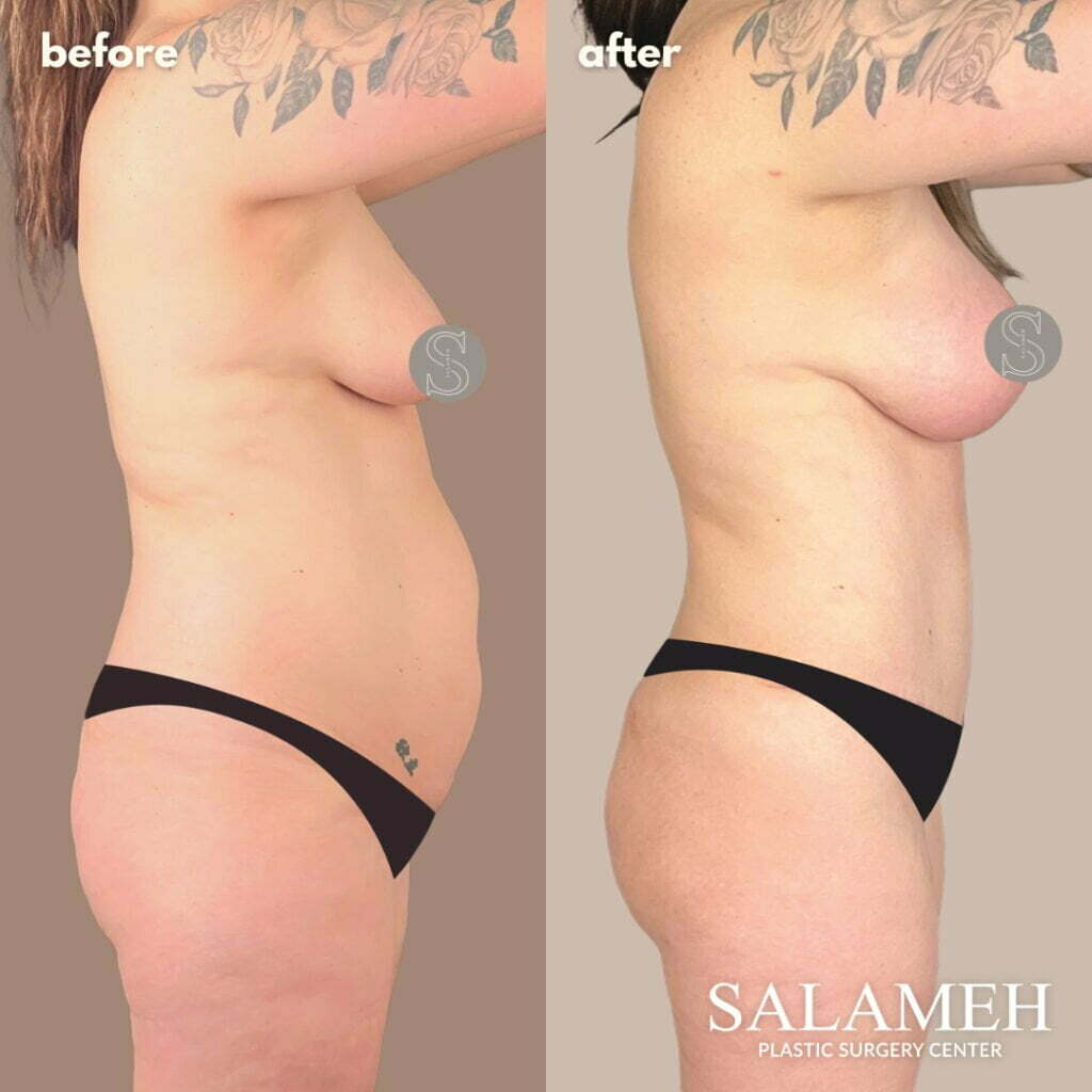 How Long After Breast Reduction Will I Know My Size - Salameh Plastic  Surgery Center