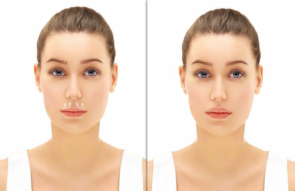 Upper lip lift surgery illustration with a woman on white background.