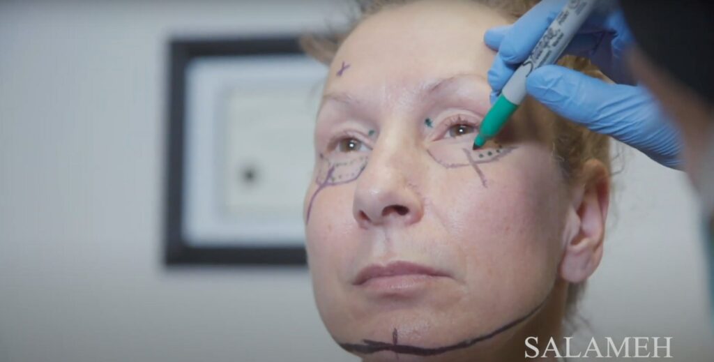 blepharoplasty surgery marking.