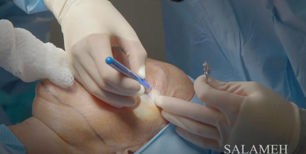 Dr.  Saba performing blepharoplasty or eyelid surgery.