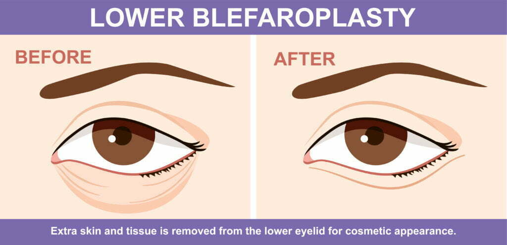 Illustration of lower blepharoplasty before and after results.