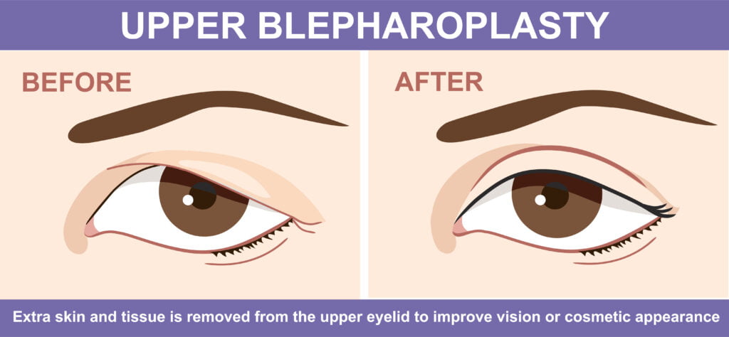 Illustration of upper blepharoplasty before and after.