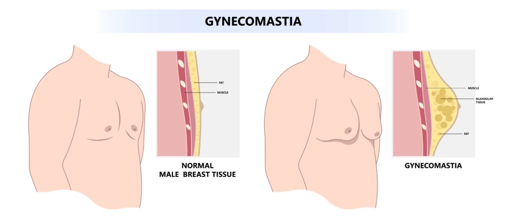 Gynecomastia vs. Fat: Key Differences Illustration.