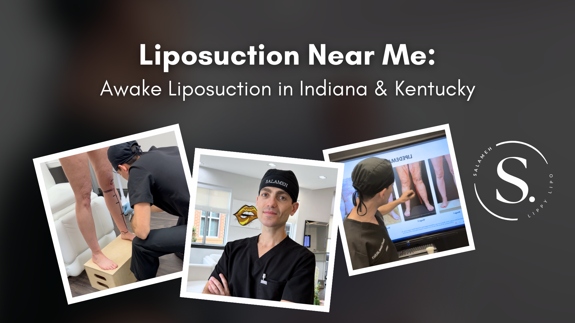 Arms Liposuction Near Me Aesthetic Results Guaranteed