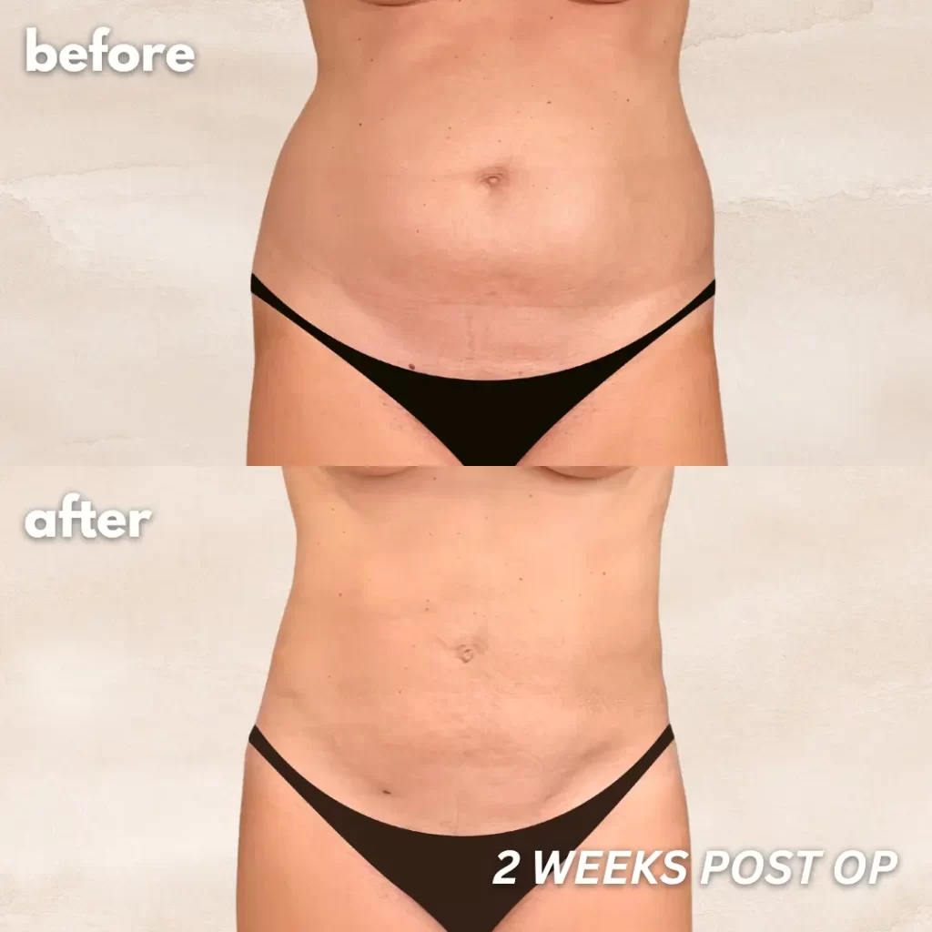 360 Lipo Without Tummy Tuck: Things You Need to Know - Salameh Plastic  Surgery Center