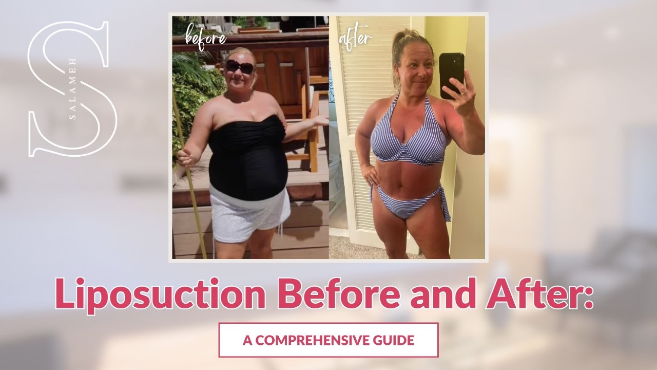 Liposuction Before and After: A Comprehensive Guide