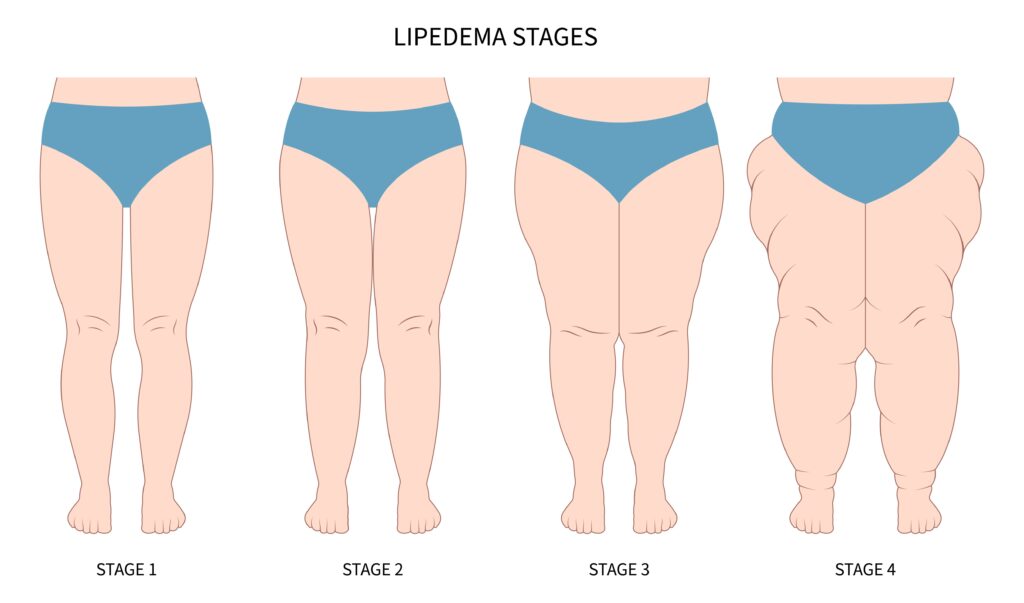 Lipedema stage illustration. Photo shows development of lipedema from stage 1 Lipedema, Stage 2 Lipedema, Stage 3 Lipedema, and Stage 4 Lipedema.