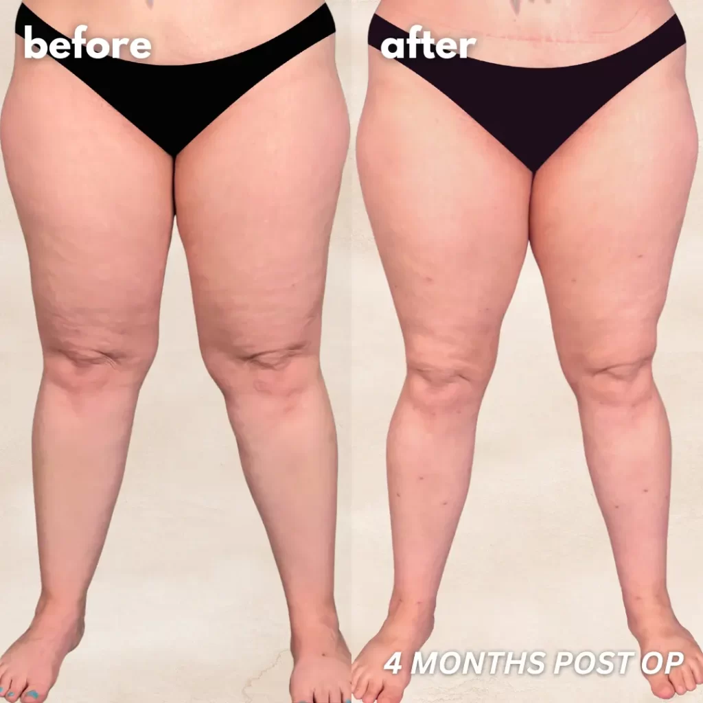 Awake Lipo Lipedema Treatment Salameh Plastic Surgery Center