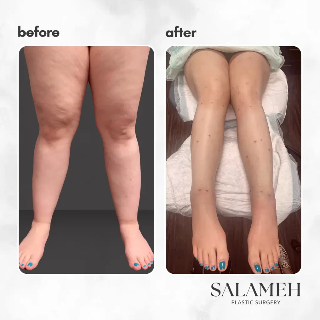 lippylipo lipedema treatment before and after