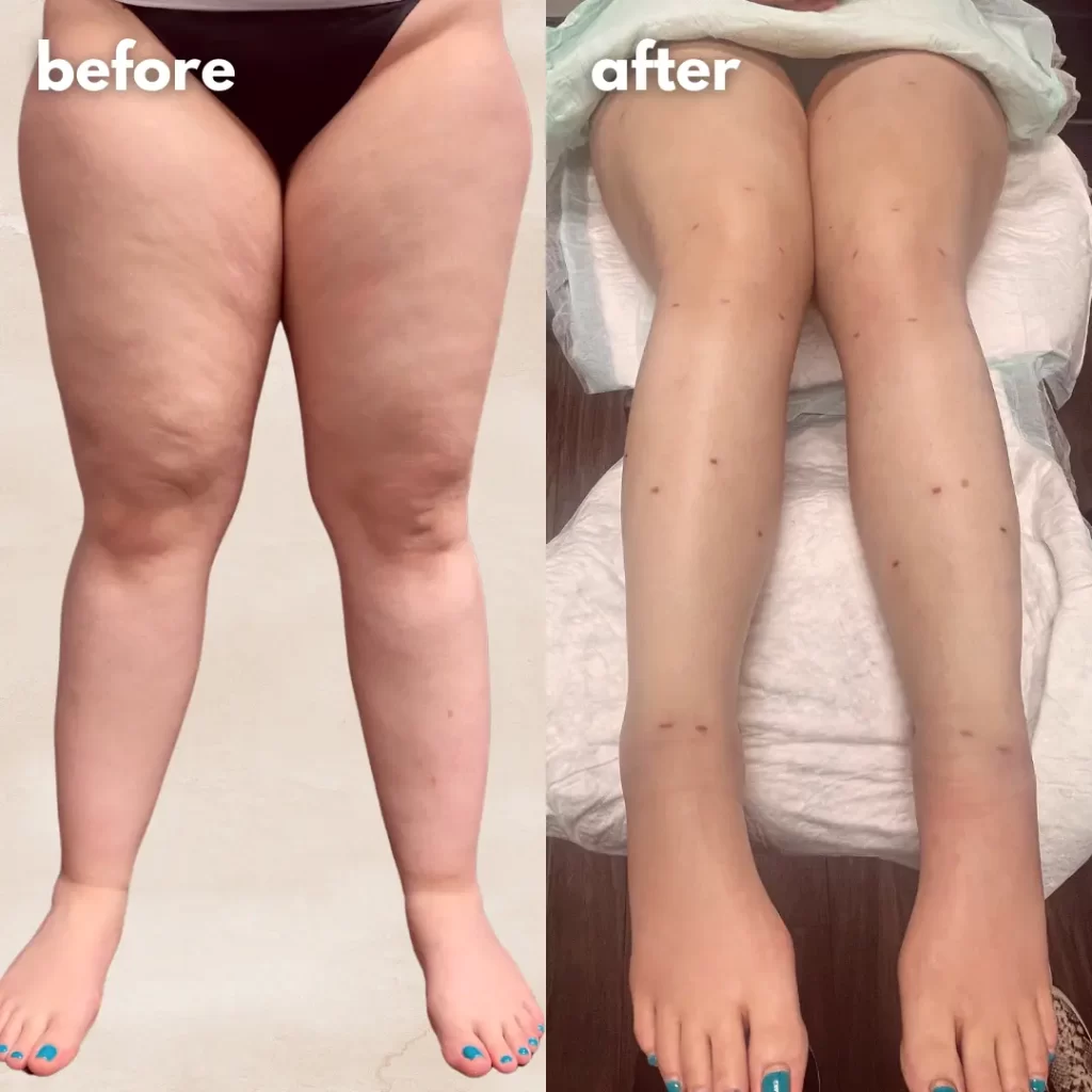 Lipedema before and after photos.