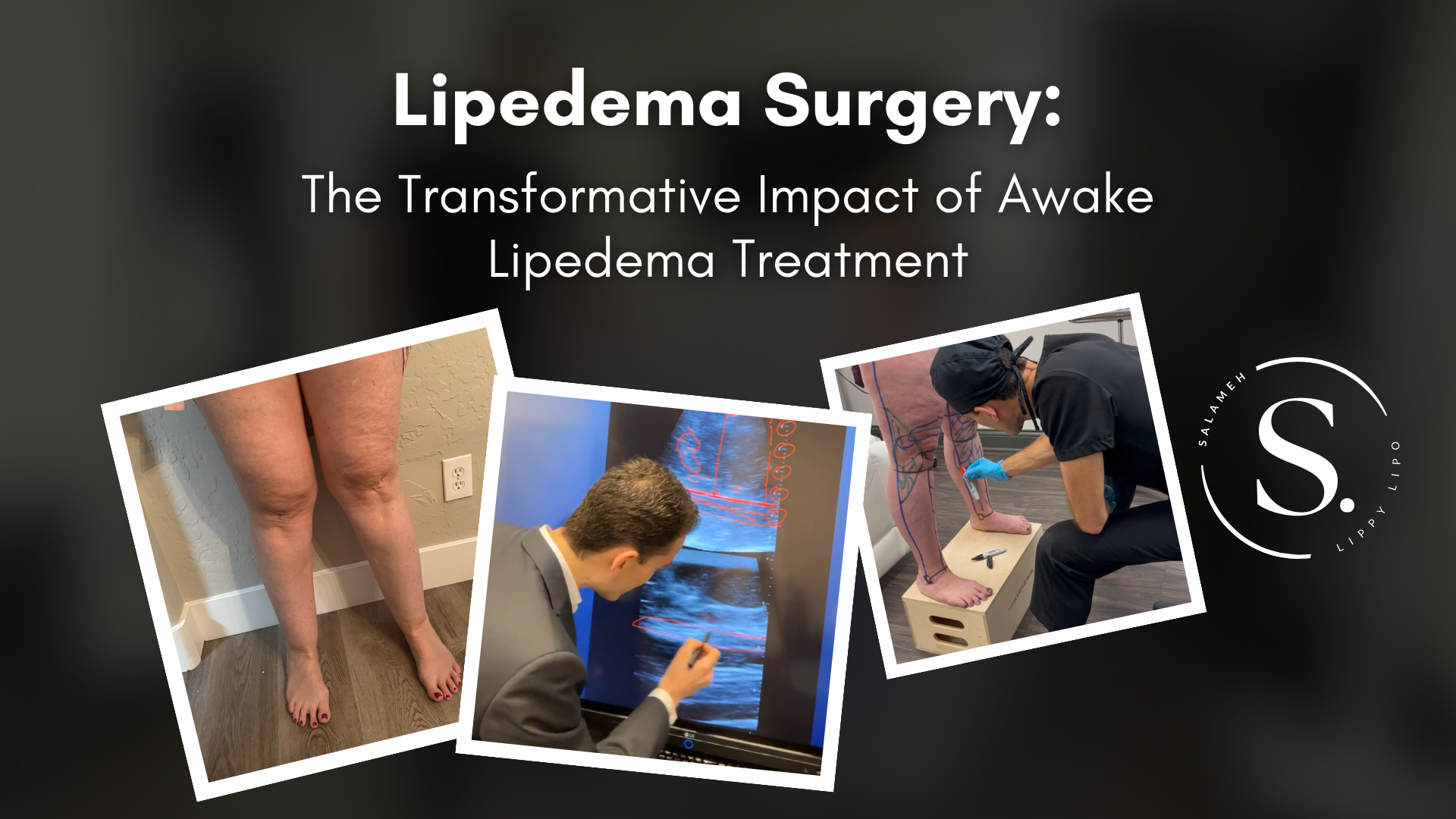 The Transformative Impact Of Awake Lipedema Surgery