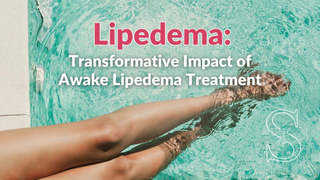 Lipedema Surgery: The Transformative Impact of Awake Lipedema Treatment