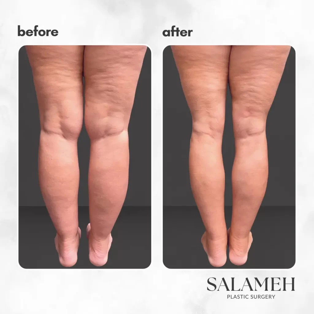 Before and after images showcasing the transformation of a woman's legs following lipedema lipo treatment.